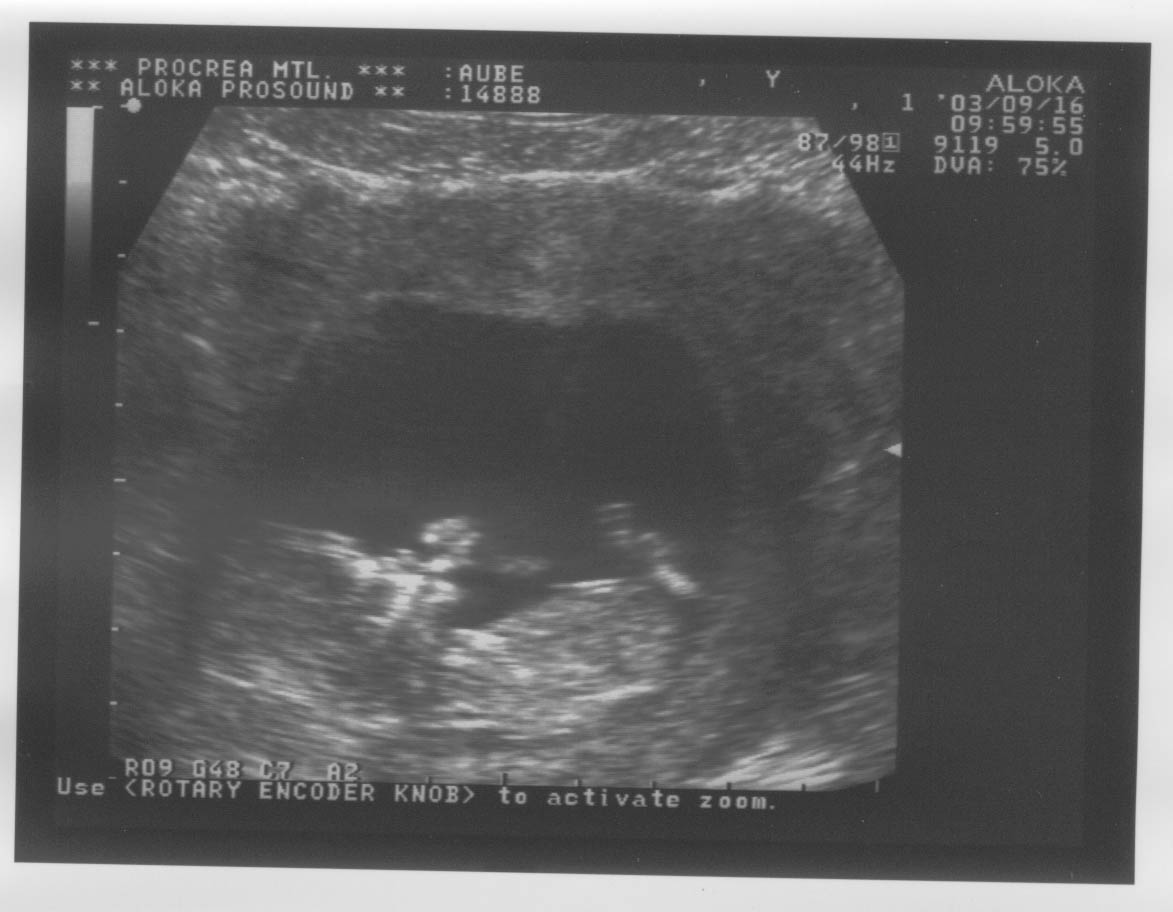 12 week baby ultrasound